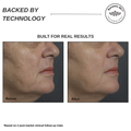 Sensilift Smart RF Skin-Firming