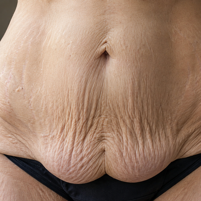 Significant loose skin